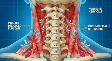 Grafica medica che mostra le vertebre cervicali e i micro-cristalli di tensione che bloccano i muscoli del collo