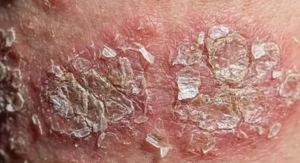 Dettaglio macroscopico di pelle affetta da psoriasi che mostra la formazione di placche argentee secche e dure
